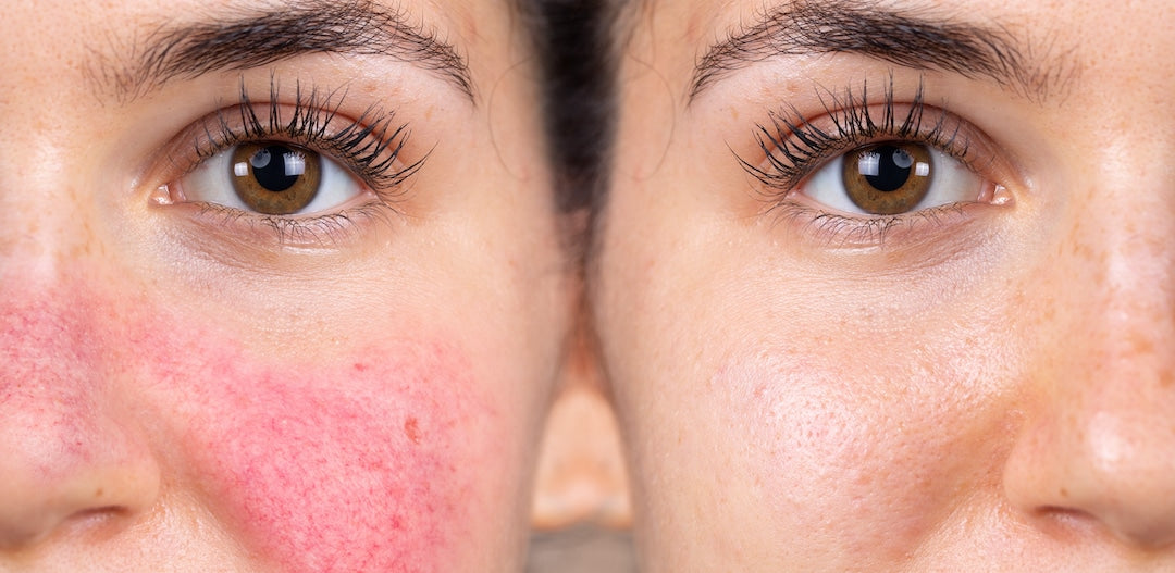 Slik forbereder du moden hud med rosacea før sminke